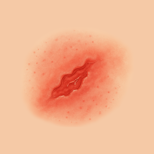 Gezeichnetes Bild einer Wunde