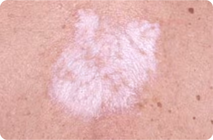 Leiden Sie an Lichen Sclerosus?