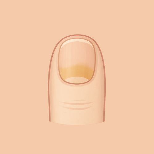 Gezeichnetes Bild von Nagelpilz