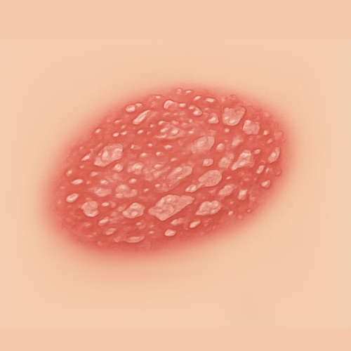 Gezeichnetes Bild einer Psoriasis