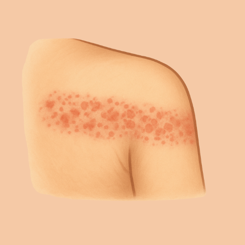 Gezeichnetes Bild eines Ausschlags über der Schulter