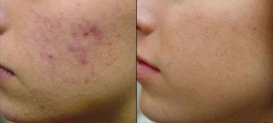 EMUAID Overnight Akne Behandlung 1oz