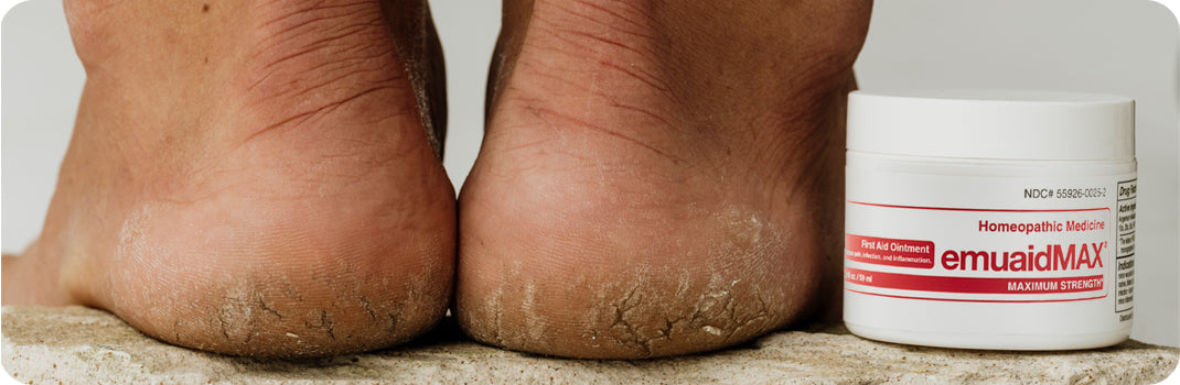 EMUAID Krankheitserreger EMUAID und beseitigt Plantar- und Palmerwarzen ohne Vereisung oder Verbrennung*.