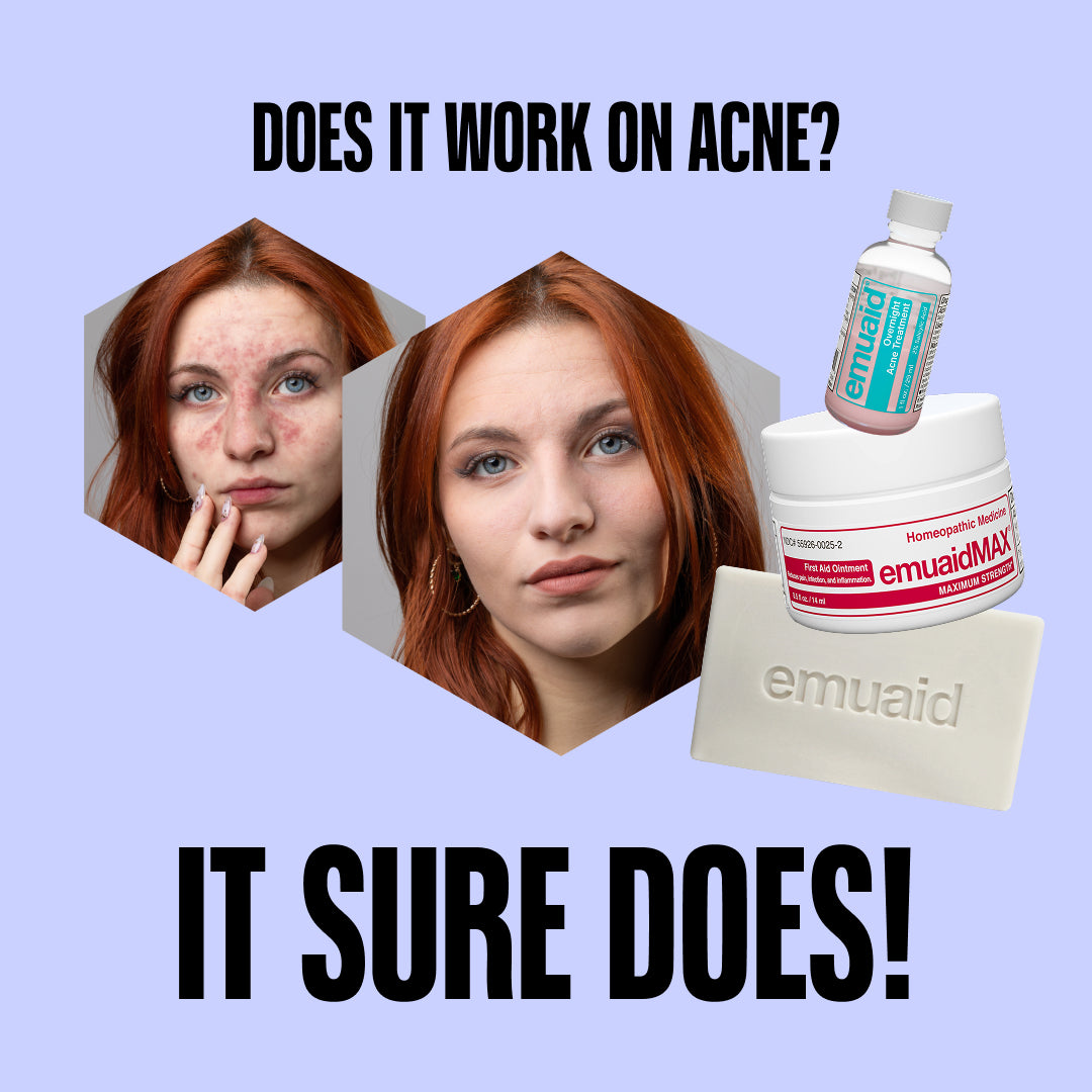 EMUAID Akne-Reinigungs-Trio