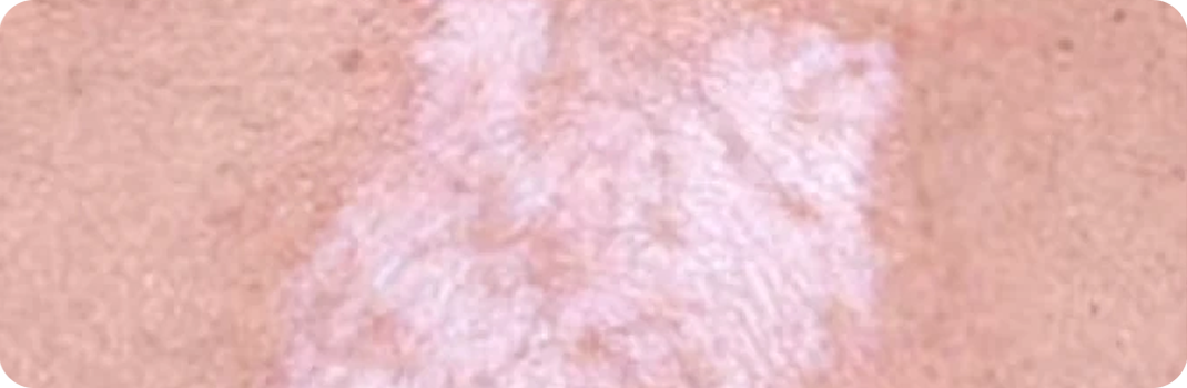 Leiden Sie an Lichen Sclerosus?
